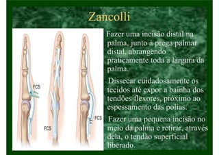 Zancolli
• Fazer uma incisão distal na
palma, junto à prega palmar
distal, abrangendo
praticamente toda a largura da
palma.
• Dissecar cuidadosamente os
tecidos até expor a bainha dos
tendões flexores, próximo ao
espessamento das polias.
• Fazer uma pequena incisão no
meio da palma e retirar, através
dela, o tendão superficial
liberado.
 