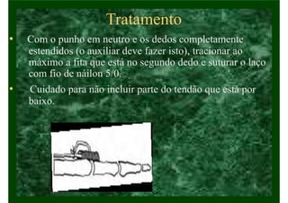 Tratamento
• Com o punho em neutro e os dedos completamente
estendidos (o auxiliar deve fazer isto), tracionar ao
máximo a fita que está no segundo dedo e suturar o laço
com fio de náilon 5/0.
• Cuidado para não incluir parte do tendão que está por
baixo.
 