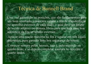 Técnica de Bunnell Brand
Uma vez garantidas as posições, que são fundamentais para
um bom resultado, começara suturar a fita de transferência
no aparelho extensor de cada dedo, o qual deve ser limpo
de tecido adiposo ou demais fibras para que haja uma boa
aderência da fita ao tendão extensor.
Aplicar uma tração máxima na fita e suturar em três locais
diferentes, para garantir uma boa segurança da sutura.
Começar sempre pelas laterais, isto é, pelo segundo ou
quinto dedo, e só depois completar a sutura no terceiro e
quarto dedos.
 