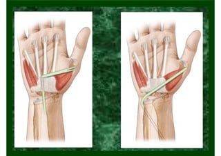 Lesão de Nervo Ulnar