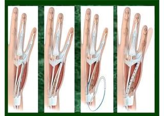 Lesão de Nervo Ulnar