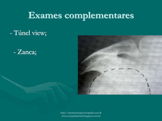 Exames complementares
- Túnel view;
- Zanca;
http://traumatologiaeortopedia.com &
www.ortopediabrasil.blogspot.com.br
 