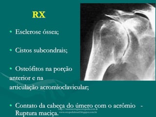 RX
• Esclerose óssea;
• Cistos subcondrais;
• Osteófitos na porção
anterior e na
articulação acromioclavicular;
• Contato da cabeça do úmero com o acrômio -
Ruptura maciça.
http://traumatologiaeortopedia.com &
www.ortopediabrasil.blogspot.com.br
 