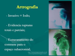 Artrografia
- Invasivo = Iodo;
- Evidencia rupturas
totais e parciais;
- Extravasamento do
contraste para o
espaço subacromial;
http://traumatologiaeortopedia.com &
www.ortopediabrasil.blogspot.com.br
 