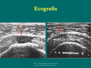 Ecografia
http://traumatologiaeortopedia.com &
www.ortopediabrasil.blogspot.com.br
 