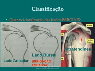 Classificação
• Quanto à localização das lesões PARCIAIS:
Lado Bursal
(IRRIGAÇÃO
ESCASSA)
Lado Articular
Intratendínea
http://traumatologiaeortopedia.com &
www.ortopediabrasil.blogspot.com.br
 