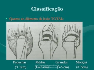 Classificação
• Quanto ao diâmetro da lesão TOTAL:
Pequenas Médias Grandes Maciças
(< 1cm) (1 a 3 cm) (3-5 cm) (> 5cm)
http://traumatologiaeortopedia.com &
www.ortopediabrasil.blogspot.com.br
 