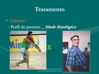 Tratamento
• Critérios:
- Perfil do paciente _ Idade fisiológica
X
http://traumatologiaeortopedia.com &
www.ortopediabrasil.blogspot.com.br
 