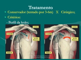 Tratamento
• Conservador (tentado por 3-6m) X Cirúrgico;
• Critérios:
- Perfil da lesão;
http://traumatologiaeortopedia.com &
www.ortopediabrasil.blogspot.com.br
 
