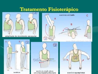 Tratamento Fisioterápico
http://traumatologiaeortopedia.com &
www.ortopediabrasil.blogspot.com.br
 