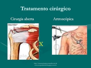 Tratamento cirúrgico
Cirurgia aberta Artroscópica
X
http://traumatologiaeortopedia.com &
www.ortopediabrasil.blogspot.com.br
 