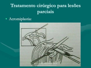 Tratamento cirúrgico para lesões
parciais
• Acromiplastia:
http://traumatologiaeortopedia.com &
www.ortopediabrasil.blogspot.com.br
 