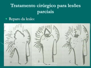 Tratamento cirúrgico para lesões
parciais
• Reparo da lesão:
http://traumatologiaeortopedia.com &
www.ortopediabrasil.blogspot.com.br
 
