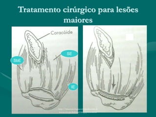 Tratamento cirúrgico para lesões
maiores
SE
IE
SbE
http://traumatologiaeortopedia.com &
www.ortopediabrasil.blogspot.com.br
 