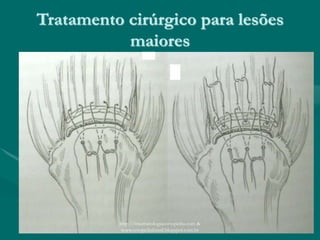 Tratamento cirúrgico para lesões
maiores
http://traumatologiaeortopedia.com &
www.ortopediabrasil.blogspot.com.br
 