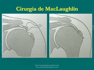 Cirurgia de MacLaughlin
http://traumatologiaeortopedia.com &
www.ortopediabrasil.blogspot.com.br
 