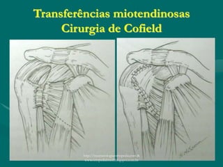 Transferências miotendinosas
Cirurgia de Cofield
http://traumatologiaeortopedia.com &
www.ortopediabrasil.blogspot.com.br
 