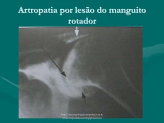 Artropatia por lesão do manguito
rotador
http://traumatologiaeortopedia.com &
www.ortopediabrasil.blogspot.com.br
 