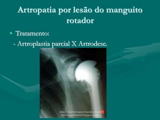 Artropatia por lesão do manguito
rotador
• Tratamento:
- Artroplastia parcial X Artrodese.
http://traumatologiaeortopedia.com &
www.ortopediabrasil.blogspot.com.br
 