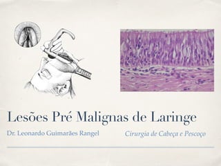 Cirurgia de Cabeça e Pescoço
Lesões Pré Malignas de Laringe
Dr. Leonardo Guimarães Rangel
nancy and no treatment is recommended.
Squamous cell hyperplasia. This is a benign change in
which the epithelium becomes thicker without cellular
FIGURE 2. Pseudostratified ciliated columnar ("respiratory’’)
epithelium with interspersed goblet cells. [Color figure can be
viewed in the online issue, which is available at
wileyonlinelibrary.com.]
 