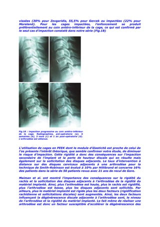 Les cages intervertébrales cervicales.dr manzo norbert.