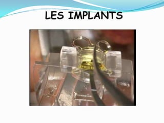 LES IMPLANTS
 