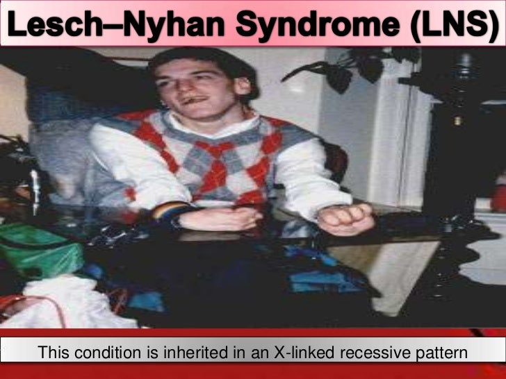 a paper on lesch nyhan disease Medical research for lesch-nyhan syndrome including cure research, prevention research, diagnostic research, and basic research. a paper on lesch nyhan disease Medical research for lesch-nyhan syndrome including cure research, prevention research, diagnostic research, and basic research.