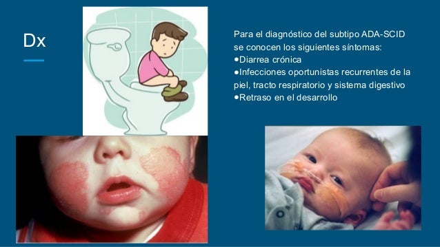 SCID symptoms what is ADA