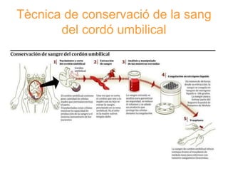 Tècnica de conservació de la sang
del cordó umbilical

 