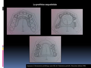 La prothèse sequelettée
Lejoyeux.J, Restauration prothétique amovible de l’édentation partielle. Deuxième édition:1980.
 