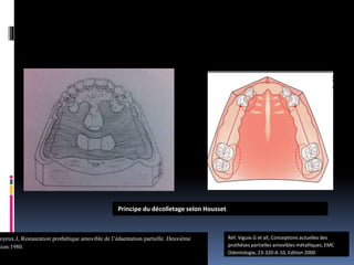 Réf. Viguie.G et all, Conceptions actuelles des
prothèses partielles amovibles métalliques, EMC
Odontologie, 23-320-A-10, Edition 2000
oyeux.J, Restauration prothétique amovible de l’édaentation partielle. Deuxième
tion:1980.
Principe du décolletage selon Housset.
 