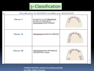 3- Classification
•PIERRE SANTONI: maîtriser la prothèse partielle
amovible ; édition cdp 2004
 