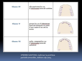 •PIERRE SANTONI: maîtriser la prothèse
partielle amovible ; édition cdp 2004
 
