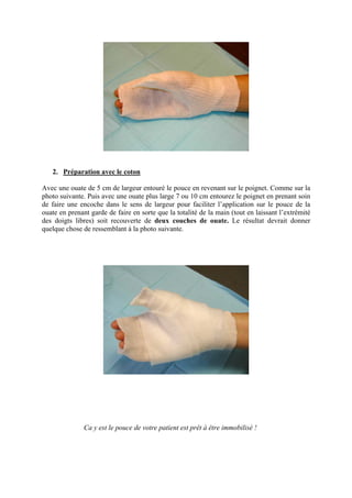 2. Préparation avec le coton

Avec une ouate de 5 cm de largeur entouré le pouce en revenant sur le poignet. Comme sur la
photo suivante. Puis avec une ouate plus large 7 ou 10 cm entourez le poignet en prenant soin
de faire une encoche dans le sens de largeur pour faciliter l’application sur le pouce de la
ouate en prenant garde de faire en sorte que la totalité de la main (tout en laissant l’extrémité
des doigts libres) soit recouverte de deux couches de ouate. Le résultat devrait donner
quelque chose de ressemblant à la photo suivante.




               Ca y est le pouce de votre patient est prêt à être immobilisé !
 