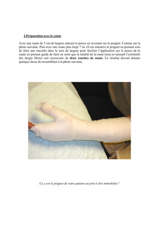 2.Préparation avec le coton

Avec une ouate de 5 cm de largeur entouré le pouce en revenant sur le poignet. Comme sur la
photo suivante. Puis avec une ouate plus large 7 ou 10 cm entourez le poignet en prenant soin
de faire une encoche dans le sens de largeur pour faciliter l’application sur le pouce de la
ouate en prenant garde de faire en sorte que la totalité de la main (tout en laissant l’extrémité
des doigts libres) soit recouverte de deux couches de ouate. Le résultat devrait donner
quelque chose de ressemblant à la photo suivante.




                Ca y est le poignet de votre patient est prêt à être immobilisé !
 