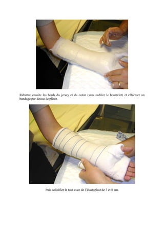 Rabattre ensuite les bords du jersey et du coton (sans oublier le bourrelet) et effectuer un
bandage par-dessus le plâtre.




                   Puis solidifier le tout avec de l’élastoplast de 3 et 8 cm.
 