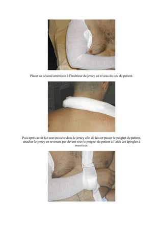 Placer un second américain à l’intérieur du jersey au niveau du cou du patient.




Puis après avoir fait une encoche dans le jersey afin de laisser passer le poignet du patient,
attacher le jersey en revenant par devant sous le poignet du patient à l’aide des épingles à
                                         nourrices.
 