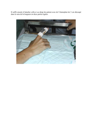 Il suffit ensuite d’attacher celle-ci au doigt du patient avec de l’elastoplast de 3 cm découpé
dans le sens de la longueur en deux parties égales.
 