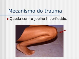 Mecanismo do trauma
 Queda com o joelho hiperfletido.
 