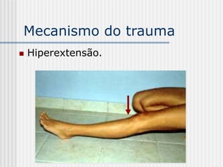 Mecanismo do trauma
 Hiperextensão.
 