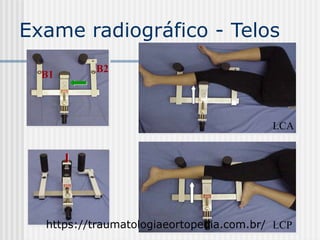 Exame radiográfico - Telos
B1
B2
LCA
LCPhttps://traumatologiaeortopedia.com.br/
 
