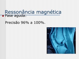 Ressonância magnética
 Fase aguda:
Precisão 96% a 100%.
 