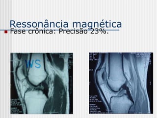 Ressonância magnética
 Fase crônica: Precisão 23%.
 