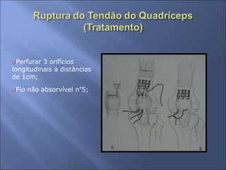 Perfurar 3 orifícios
longitudinais a distâncias
de 1cm;
Fio não absorvível n°5;
 