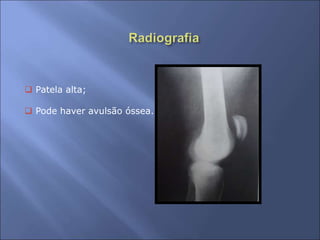 Patela alta;
 Pode haver avulsão óssea.
 