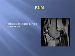  Delineia lacerações parciais
ou completas.
 