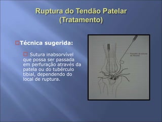 Técnica sugerida:
 Sutura inabsorvível
que possa ser passada
em perfuração através da
patela ou do tubérculo
tibial, dependendo do
local de ruptura.
 
