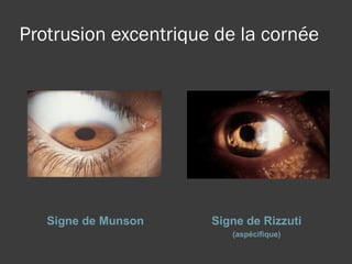Protrusion excentrique de la cornée Signe de Munson Signe de Rizzuti (aspécifique) 