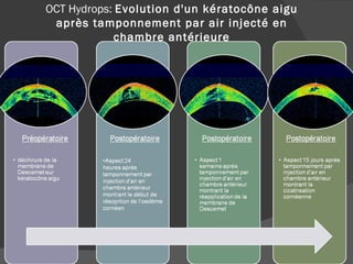 OCT Hydrops:  Evolution d'un kératocône aigu après tamponnement par air injecté en chambre antérieure 