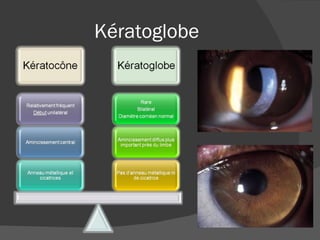 Kératoglobe 